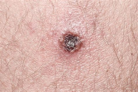 scrub typhus meaning  louise collier blog