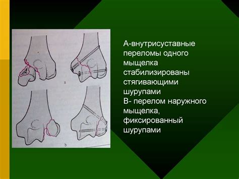 Повреждение плеча, вывихи плеча и предплечья - презентация онлайн