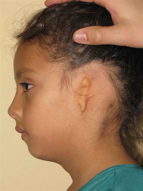 Anotia - Definition of Anotia