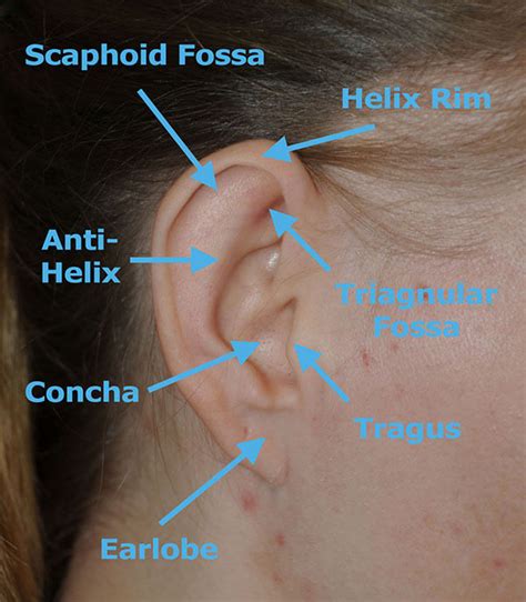 Macrotia Large Ear Reduction Prominent Ear Pinning Otoplasty