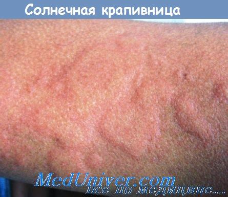 Как выглядит крапивница у детей на лице фото
