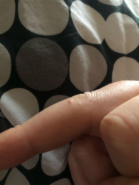 Is this a wart : r/medical