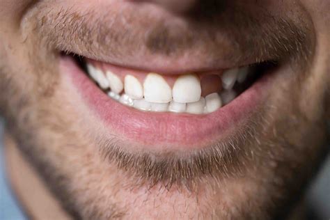 Can you get dental implants with no teeth - Dental News Network