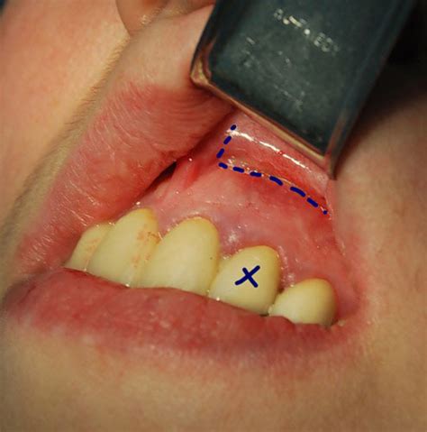 Acute Dental Periostitis: Etiology, Clinical Picture & Treatment