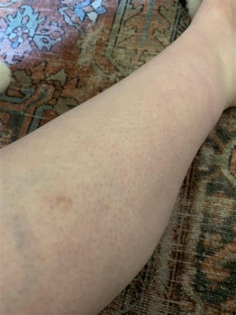 What are these dark spots on my calves and how do I get rid of them
