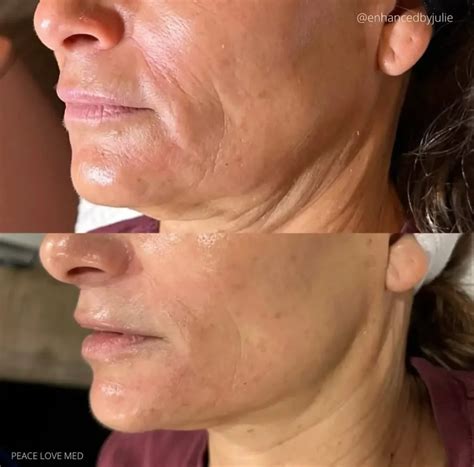 Morpheus8 Before and After - Before After Journey