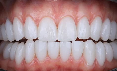 Ультратонкие виниры в стоматологической клинике Eurodental