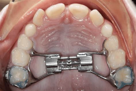 What is an expander ? | Read all you need to know here.
