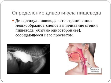 Дивертикул пищевода - презентация онлайн