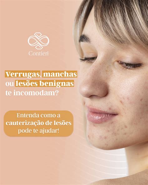 Cauterização Para Que Serve - Dra. - O que é e para que serve? A cauterização de lesões de pele é um ...