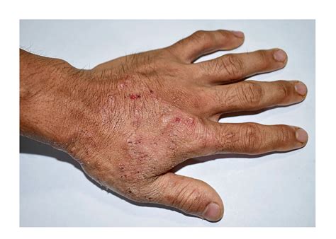 What is scabies look like?