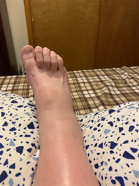 Anyone have issues with leg and feet swelling with Graves? : r
