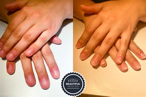 how to fix biting nails