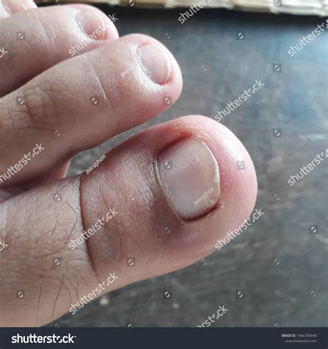 Ingrown Nailthumb Toe Skin Fungal Infection Stock Photo 1466180948