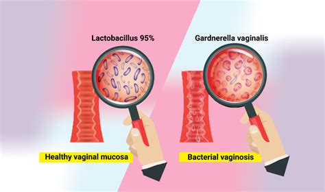 Bacterial Vaginosis | Dynamic Nutrition