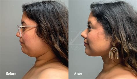 chin liposuction   hz plastic surgery