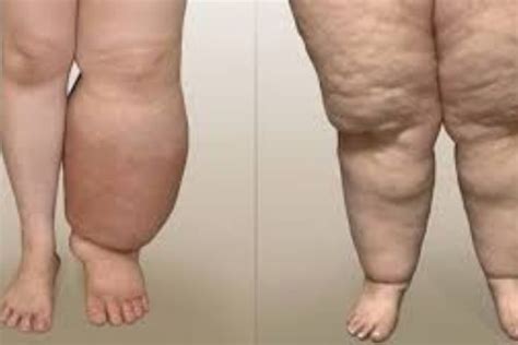 Linfedema E Lipedema - lipedema y linfedema ¿cuál es la diferencia?