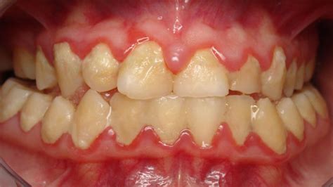 Dental Biofilms – Oral Health and its Applications - FunBuzzTime
