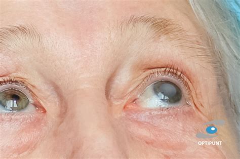 Cataratas en los ojos: causas, síntomas y tratamientos