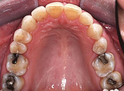 upper arch  orthodontic treatment showing  ideal alignment