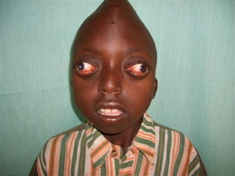 10 People With Shocking and Extreme Deformities - Listverse