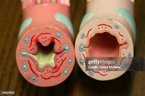 Asthma Airways Photos and Premium High Res Pictures - Getty Images