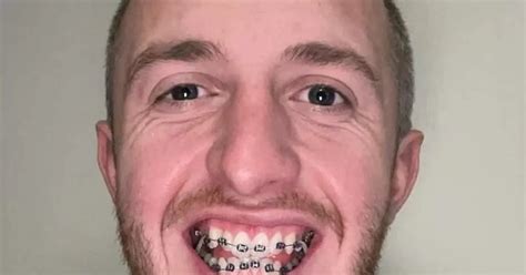 Why This Star Chose Braces: The Real Story Revealed - Veja Store Site