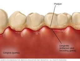 Top 3 Causes of Bleeding Gums - Shades Clinic