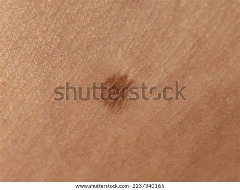 Burn Scar On Skin Background Stock Photo 2237340165 | Shutterstock