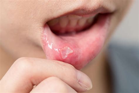 Dealing With Canker Sores Can Be Frustrating...and Painful