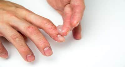 Side effects of topical steroids you should know about! | TheHealthSite.com