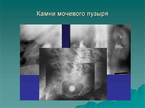 Мочекаменная болезнь - презентация онлайн