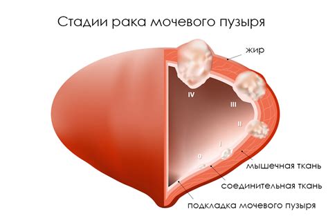 Рак мочевого пузыря: симптомы, диагностика, лечение | Университетская ...