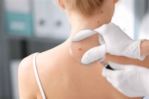 Shining A Light on Melanoma - WellWell