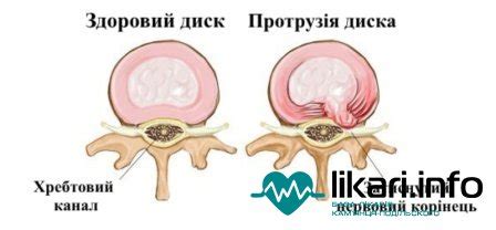 Лікування протрузії | Поняття | Підготовка | Проведення | Показання ...