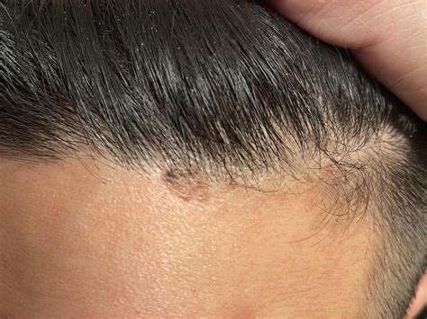 I’m not sure what’s going on my forehead. :( : r/Melanoma