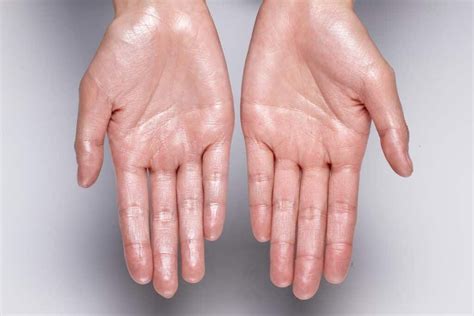 mains moites  astuces contre la transpiration des mains