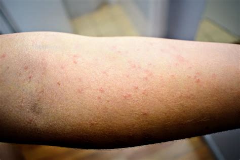 Mild Scabies Rash