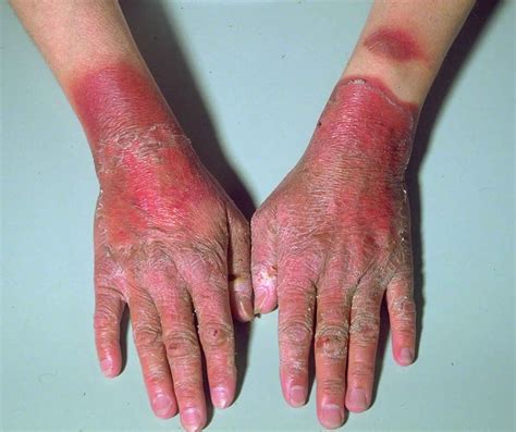 Hartnup Disease - MEDizzy