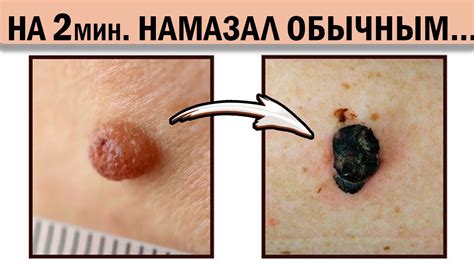 Сразу растворяет любую бородавку! 1 зубчик чеснока измельчаем, и ...