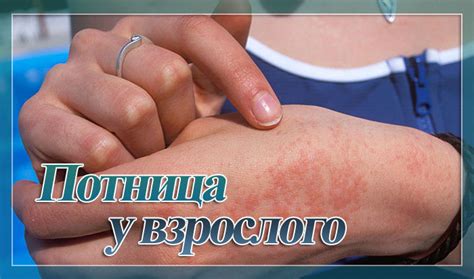 Как выглядит потница у взрослых на ногах фото