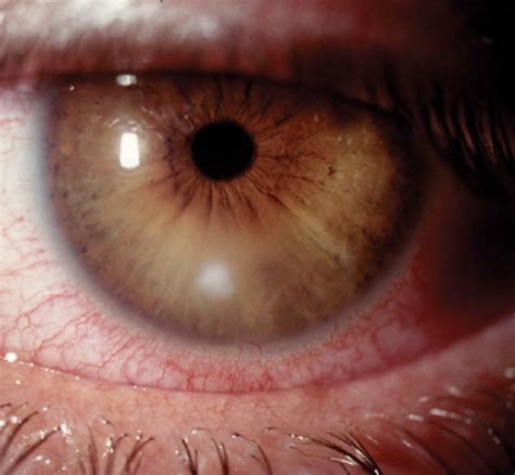 answers  bacterial keratitis treatment protocols