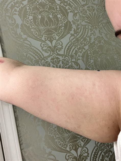 Does this look like CU or heat urticaria? : r/CholinergicUrticaria
