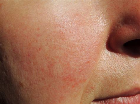 Severe Acne Rosacea