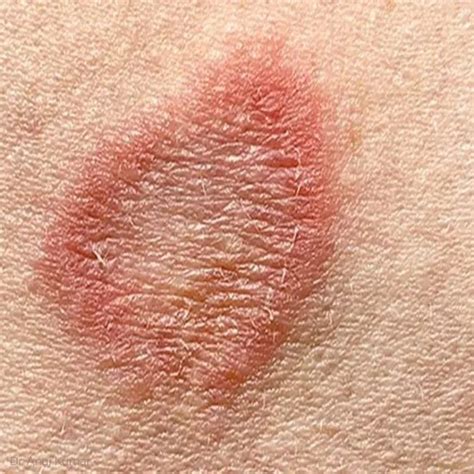 ringworm treatment dr anuj kumar