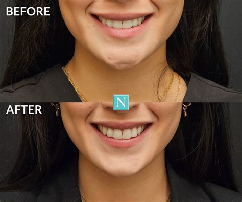 pebble chin  dimples  botox   works cost