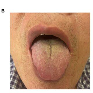 FIGURE E Diierent tongue-coating images of the three groups. (A) Thick ...