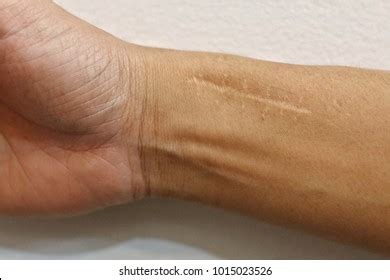 677 Scar wrist Images, Stock Photos & Vectors | Shutterstock