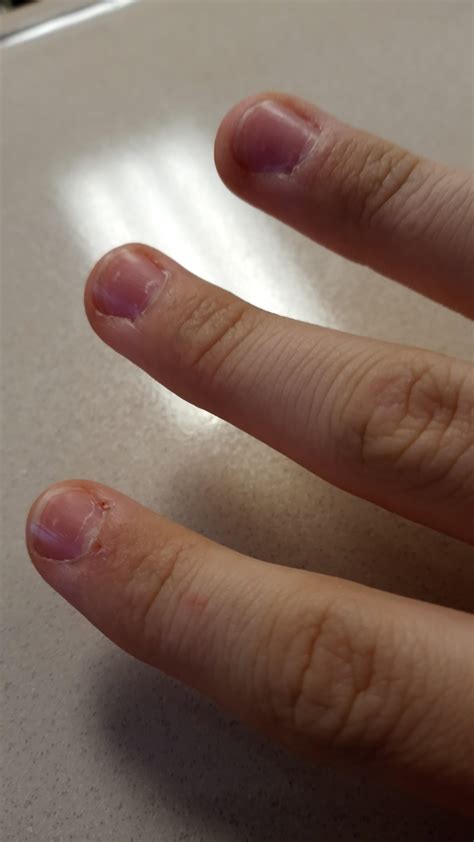 What causes my fingers to do this? It's getting on my nerves : r
