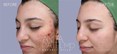 Skin Resurfacing Before & After Gallery - Dr. Anita Patel